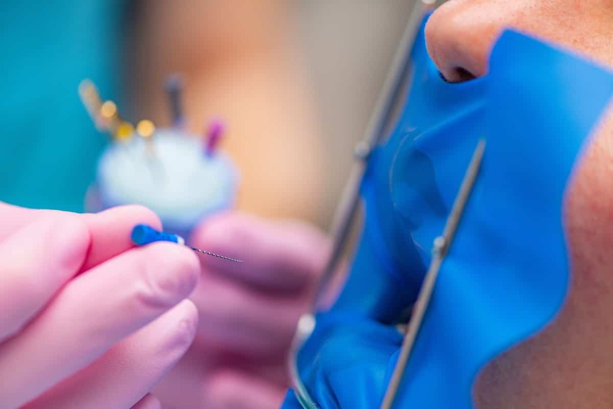 Root Canal Treatment in New Kensington